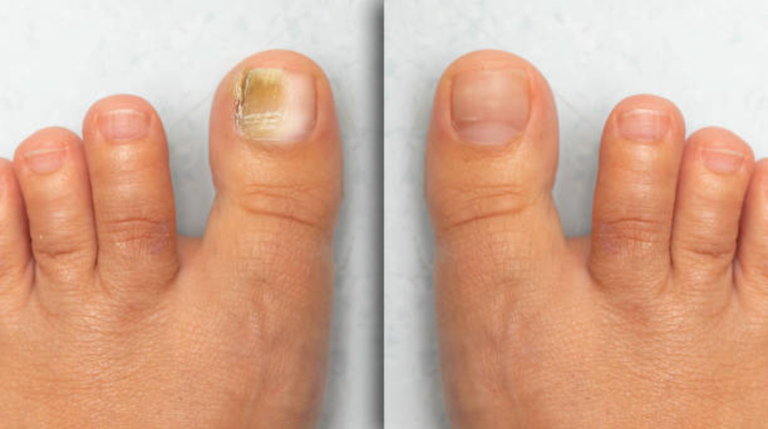 Fungal Nails